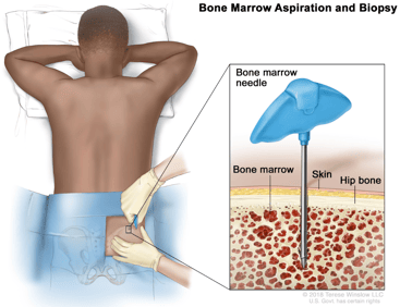 Bone Marrow Aspiration and Biopsy 